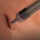 The substance, called MeTro, is injected directly on the wound and then sealed with UV light. (Image: University of Sydney)